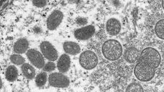 This electron microscope image shows virus particles of the monkeypox virus taken from human skin in 2003.