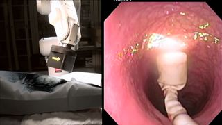 A robotic arm hovers during a colonoscopy.