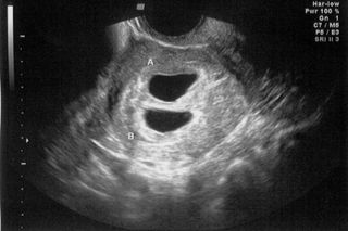 Ultrasound of twin pregnancy at approximately four weeks gestation to illustrate the Ramzi theory and how it works