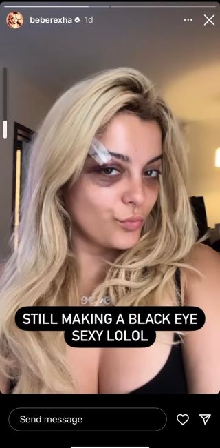 Bebe Rexha showing her black eye, writing "still making a black eye sexy lolol"
