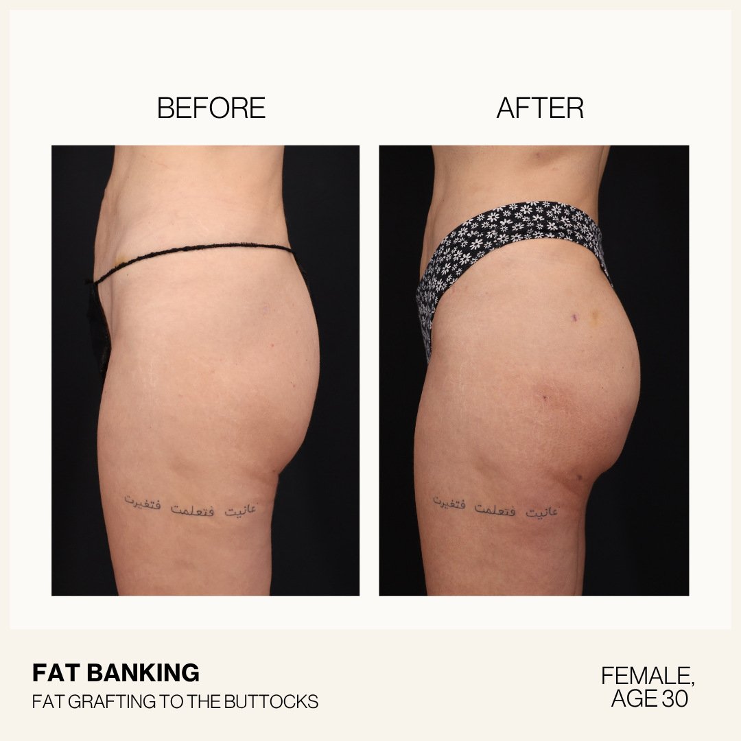 a before and after side by side image of a woman with bare legs in a swimsuit bottom, after getting fat banking transfer