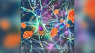 Illustration of a neuron with clumps of bright orange proteins stuck to it