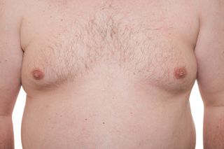 What is Gynecomastia Live Science