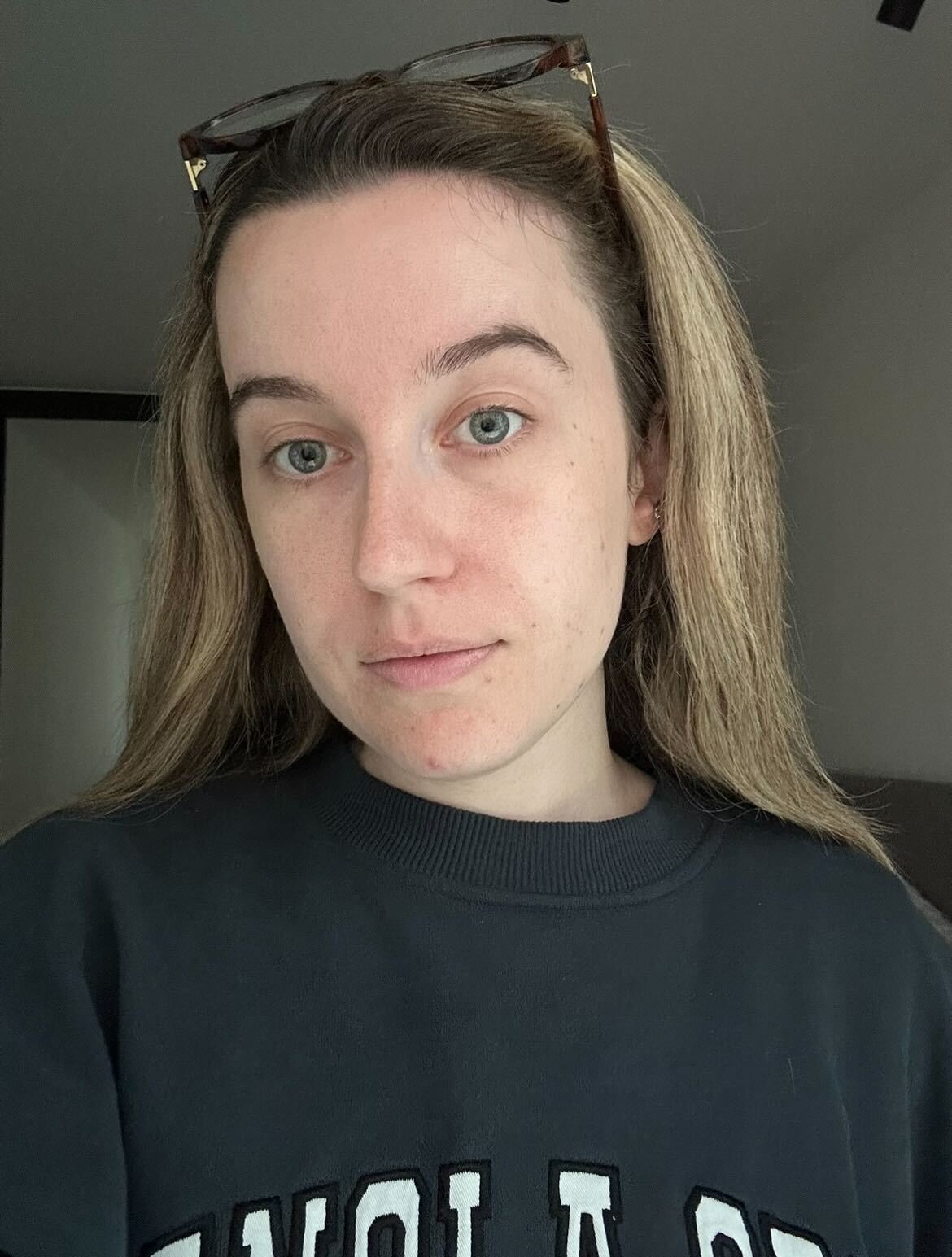 Grace Lindsay before using the Dr Dennis Gross LED Eye Mask