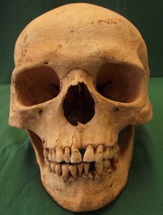 leprosy skull