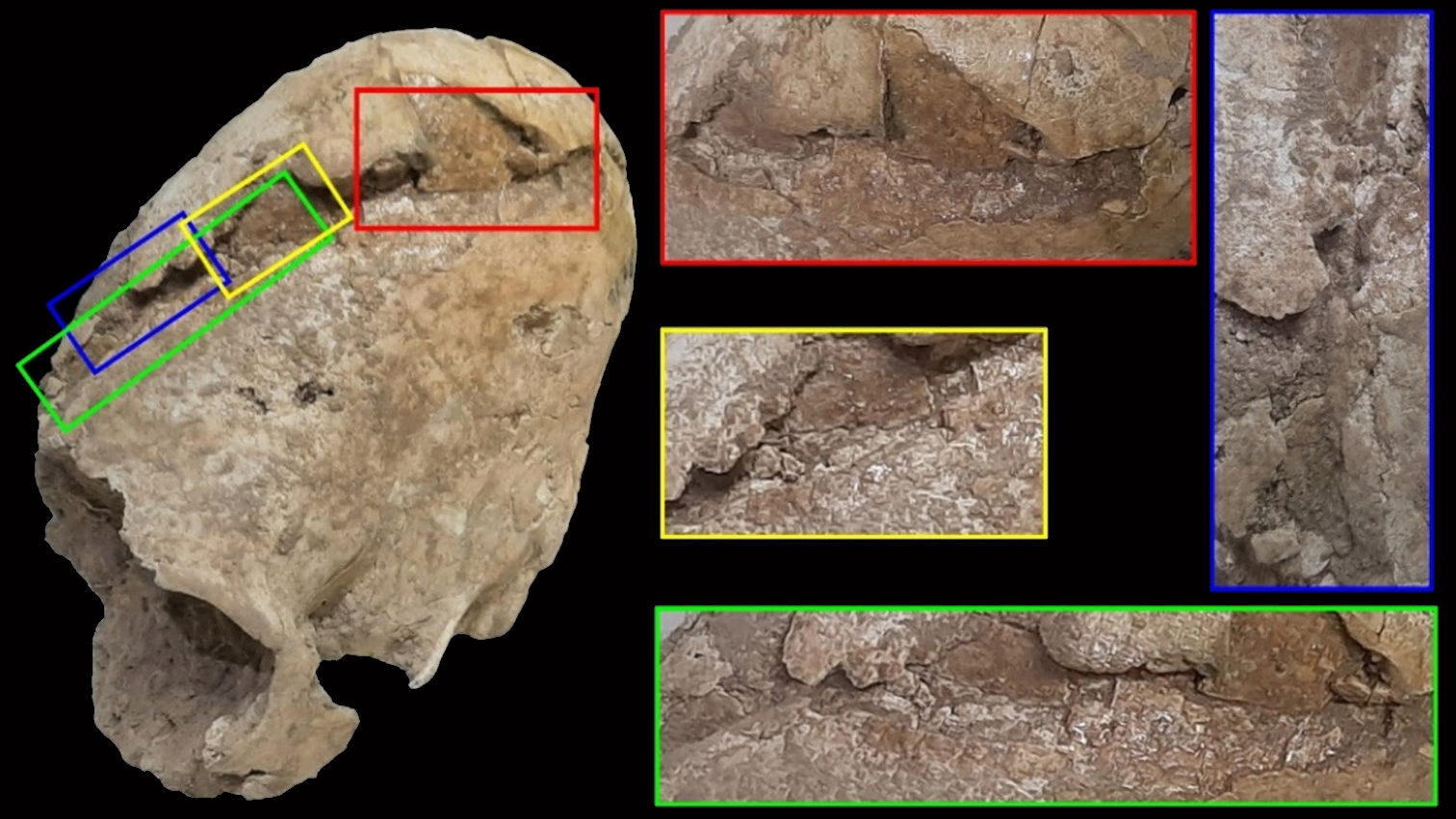 On the left, a human skull affected by annular cranial vault modification, showing injuries inflicted perimortem. On the right, close-ups of the skull fracture.