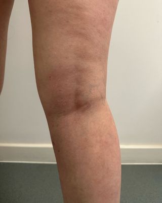 Dionne Brighton right leg after varicose vein removal