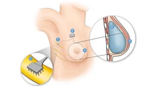 Illustration of the upper torso of a woman showing the three main components of the new breast bionic device with pop-out close-ups showing them in more detail
