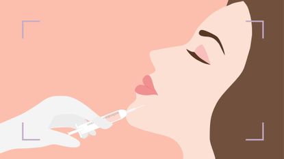 An illustration of a woman having filler, an alternative to botox, on a pink background 