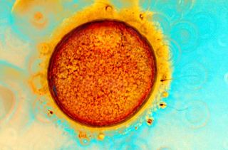 This image shows sperm and an egg (or ovum) at the moment of conception by in vitro fertilization (IVF). The egg is surrounded by protective cumulus cells around the outside surface, colored yellow. The sperm need to penetrate the membrane surrounding the
