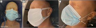 The CDC researchers used dummies for their experiments. Image A shows the dummy with an unadjusted surgical mask with large gaps on the sides; image B shows the dummy with a "double mask" (a cloth mask over a surgical mask); and image C shows the "knotted and tucked mask," in which the ear loopos of a surgical mask are knotted near the mask's edge.