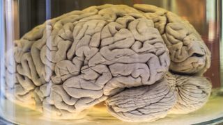 A human brain in a jar filled with liquid.