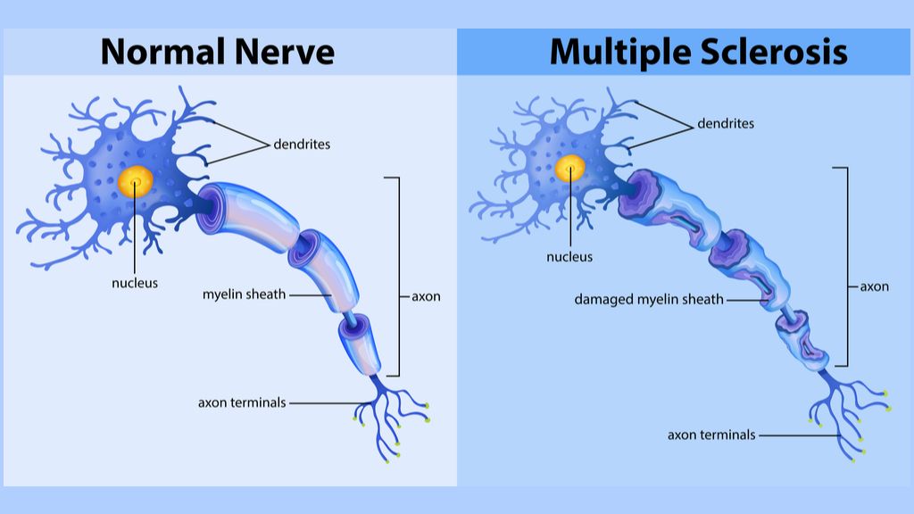 The virus behind 'mono' might trigger multiple sclerosis in some | Live ...