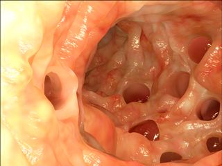 Diverticula are small pouches that form in the colon, esophagus or stomach — a condition called diverticulosis. Diverticulitis occurs when these pouches become inflamed.