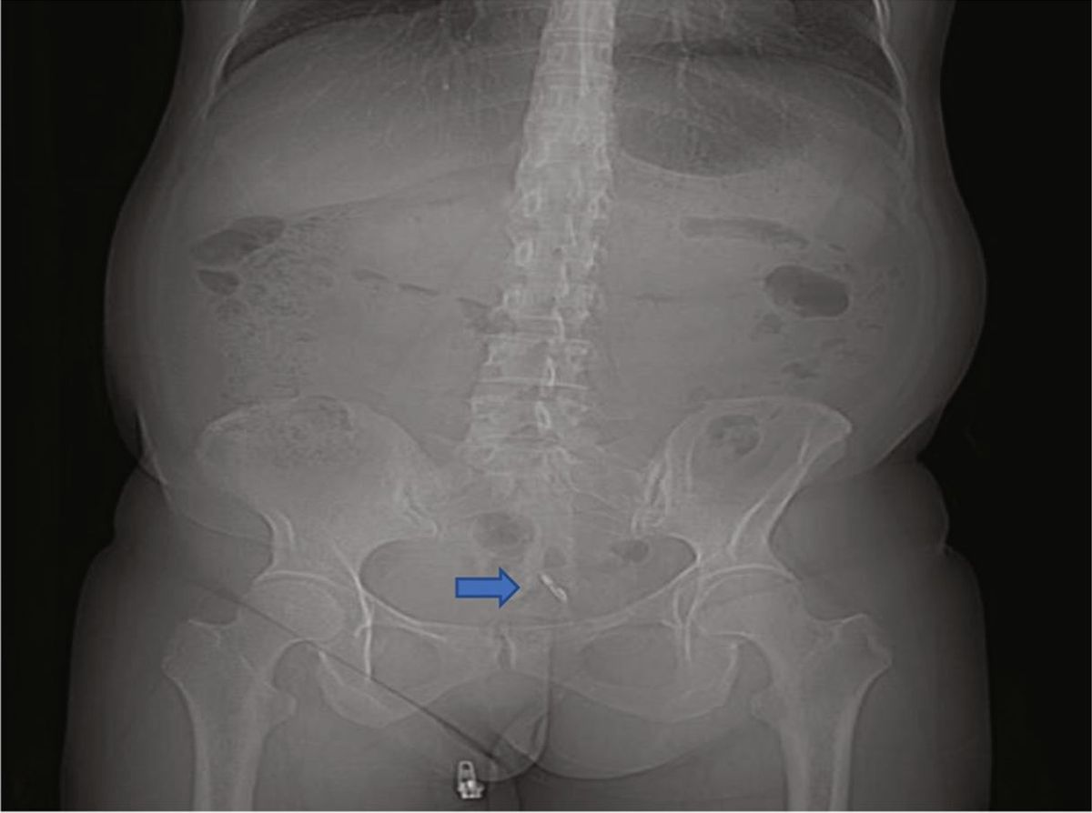 X-ray with arrow pointing to the IUD in the woman&#039;s bladder.