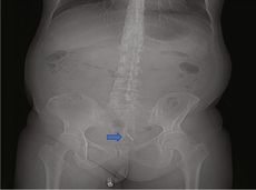 X-ray with arrow pointing to the IUD in the woman's bladder.