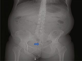 X-ray with arrow pointing to the IUD in the woman's bladder.
