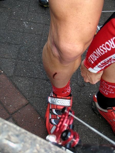 Powers displays the battle wounds