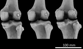 A large fabella (left), medium-sized (middle) and small (right) in three different female knees.