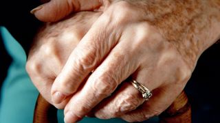 A woman with age spots on her hands