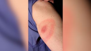Lyme disease bullseye rash pictured on a white person's arm