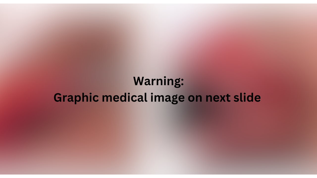Blurred image with text over the top. The text is black and in bold and reads "Warning: graphic medical image on next slide"