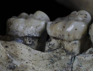 This ancient hominid jaw has marks suggesting it experienced toothpicking. 