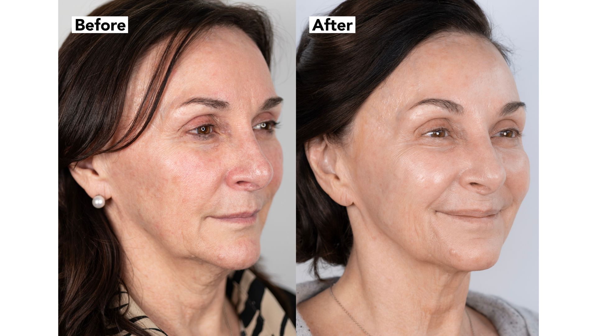 Shirley Ballas pictured before and after having Neogen Plasma treatments