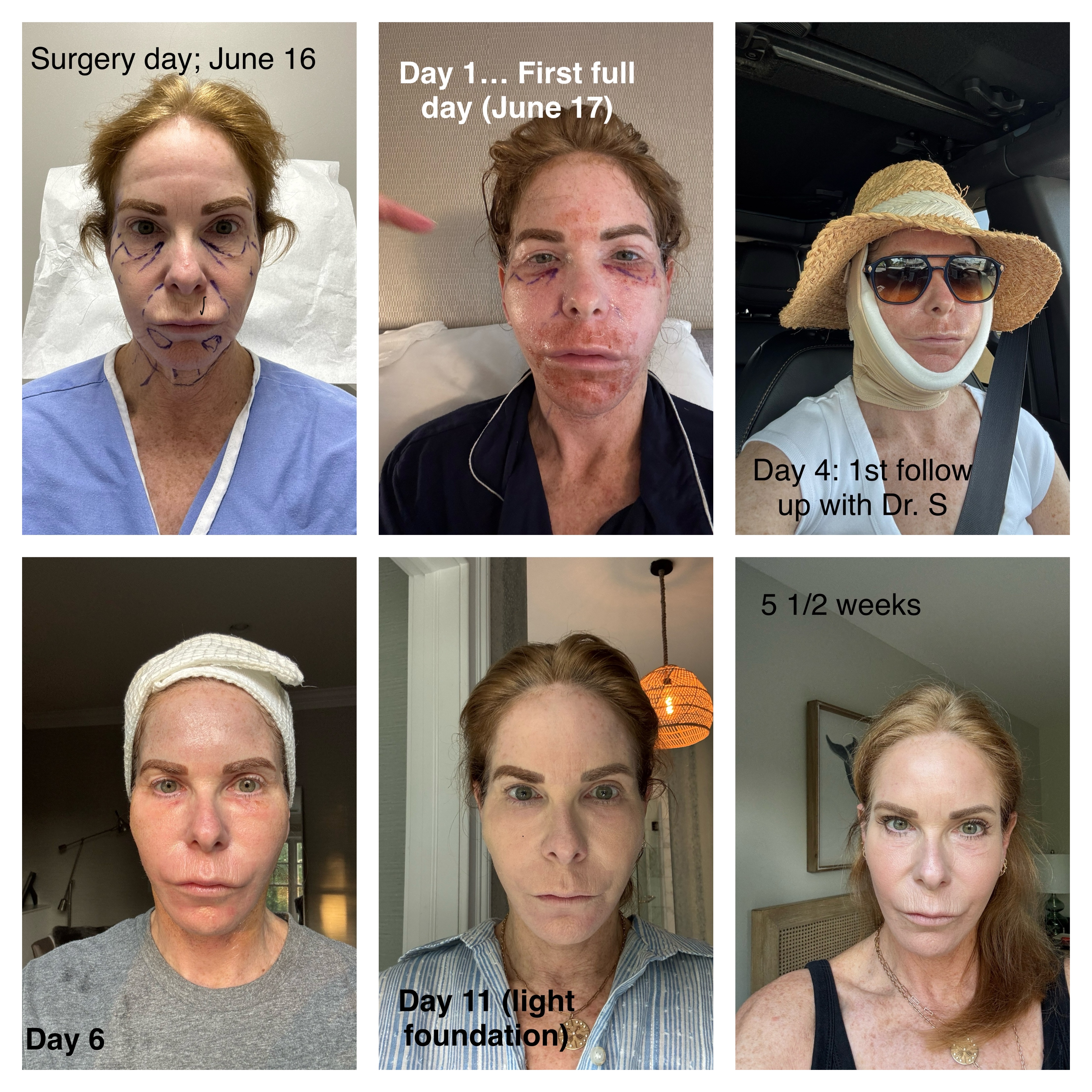 healing after a facelift timeline with six different photos of a woman&#039;s face post-surgery