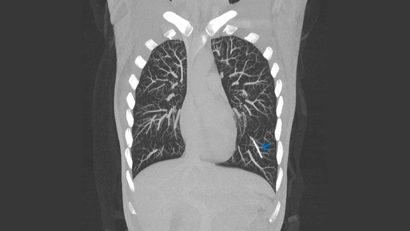 A CT scan of a woman&#039;s chest showing an implant near her lung