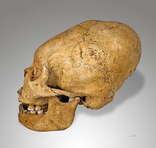 deformed peruvian skull