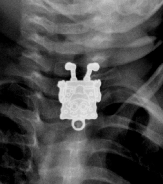 An X-ray shows a SpongeBob pendant that a toddler swallowed.