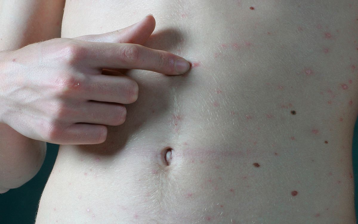 Red Bumps Around Tattoo