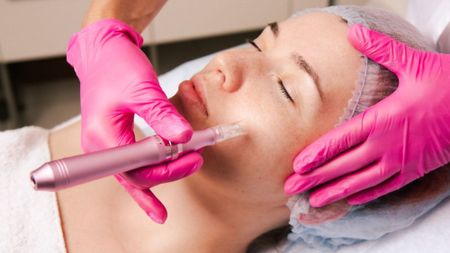 Microneedling