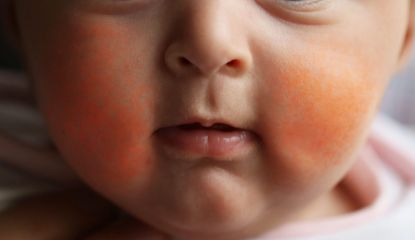 Close up picture of a child's who has slapped cheek syndrome