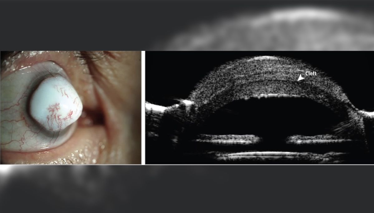 A man developed an extremely rare eye mass called a &quot;corneal keloid&quot; in his right eye. Above, images of the man&#039;s eye (left), and a cross-section of the eye showing a &quot;cleft&quot; between the cornea and the lesion (right).