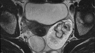 Ovarian dermoid cyst or mature cystic ovarian teratoma seen on T2 MRI image
