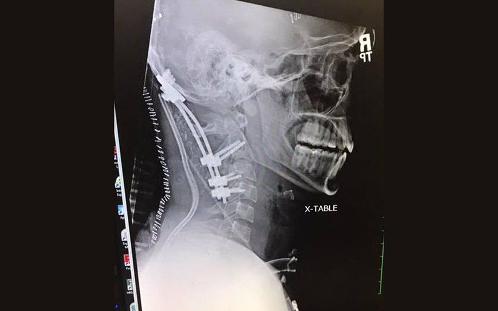 Brock Meister, a 22-year-old from Plymouth, Indiana, sustained an &quot;internal decapitation&quot; injury during a car crash in January. Above, an X-ray of Meister&#039;s head and neck after he had surgery to place a skull plate, rods and spinal screws in the area to s