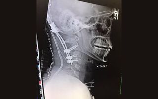Brock Meister, a 22-year-old from Plymouth, Indiana, sustained an "internal decapitation" injury during a car crash in January. Above, an X-ray of Meister's head and neck after he had surgery to place a skull plate, rods and spinal screws in the area to s