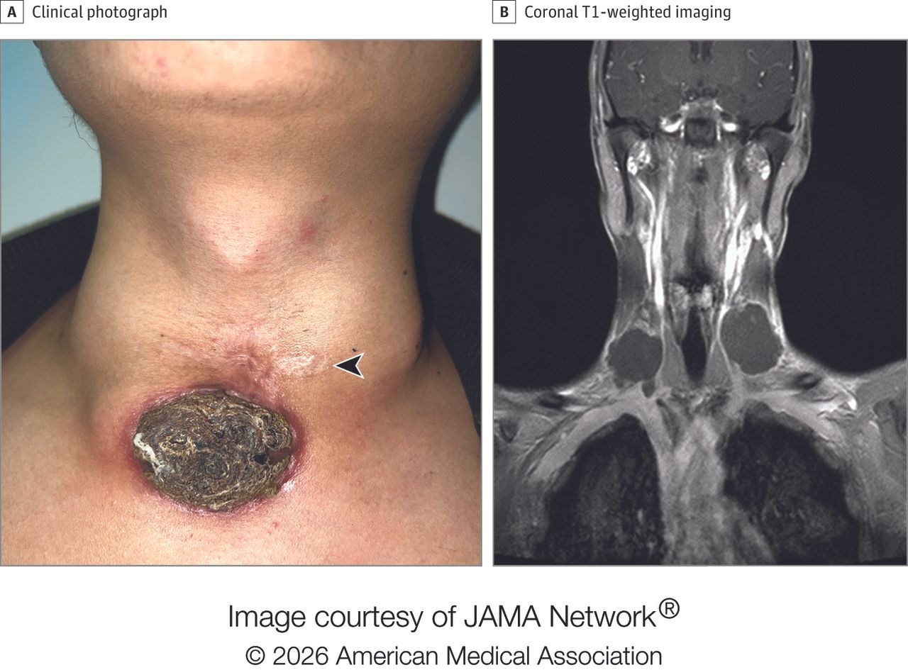 Close up of person's necrotic ulcer on the base of their neck and the MRI scan of their upper body revealing large masses on the sides of their neck.