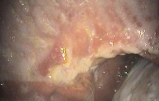 Squamous ulcer