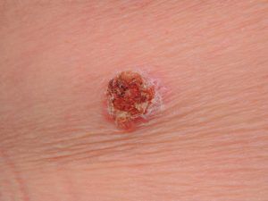 cancerous moles: Squamous cell carcinoma skin cancer