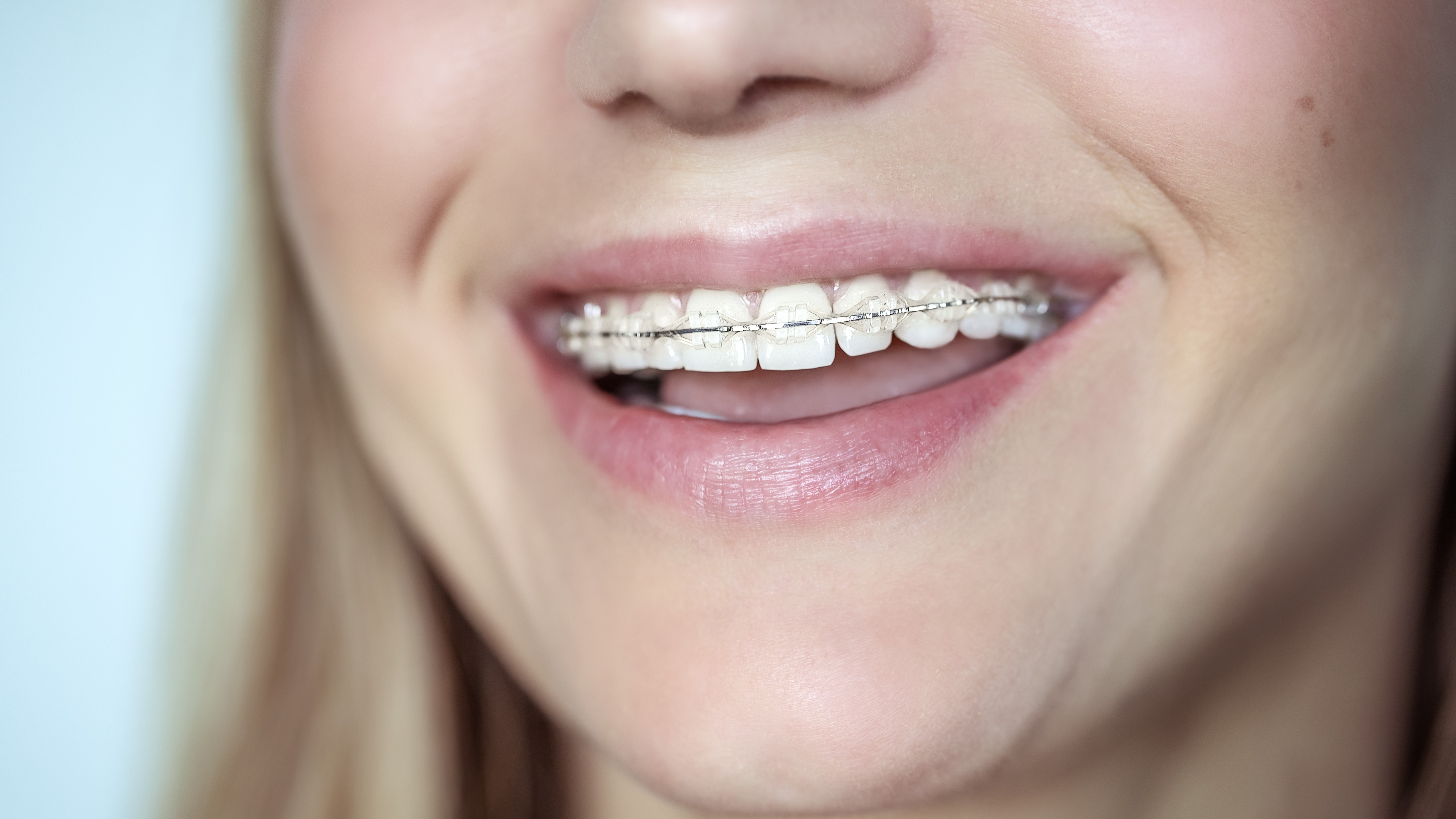 The four types of braces explained by dental experts dental News