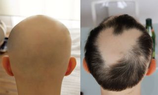 An image of a patient with alopecia universalis, a condition that results in hair loss. On the left, the patient's head before treatment with the drug tofacitinib. On the right, the head after treatment.