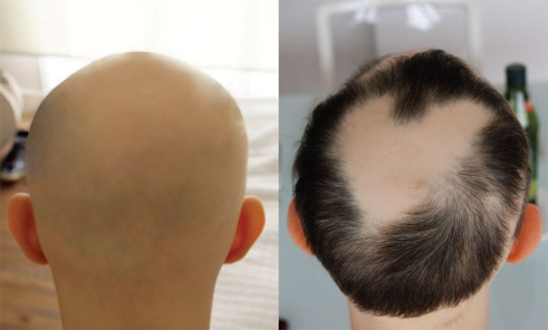 An image of a patient with alopecia universalis, a condition that results in hair loss. On the left, the patient&#039;s head before treatment with the drug tofacitinib. On the right, the head after treatment.