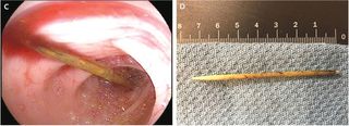 An 18-year-old man experienced life-threatening symptoms after he swallowed a toothpick. The image on the left shows the toothpick in the man's large intestine. The image on the right shows the toothpick after it was removed.