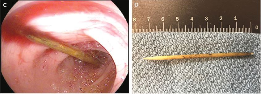 An 18-year-old man experienced life-threatening symptoms after he swallowed a toothpick. The image on the left shows the toothpick in the man&#039;s large intestine. The image on the right shows the toothpick after it was removed.