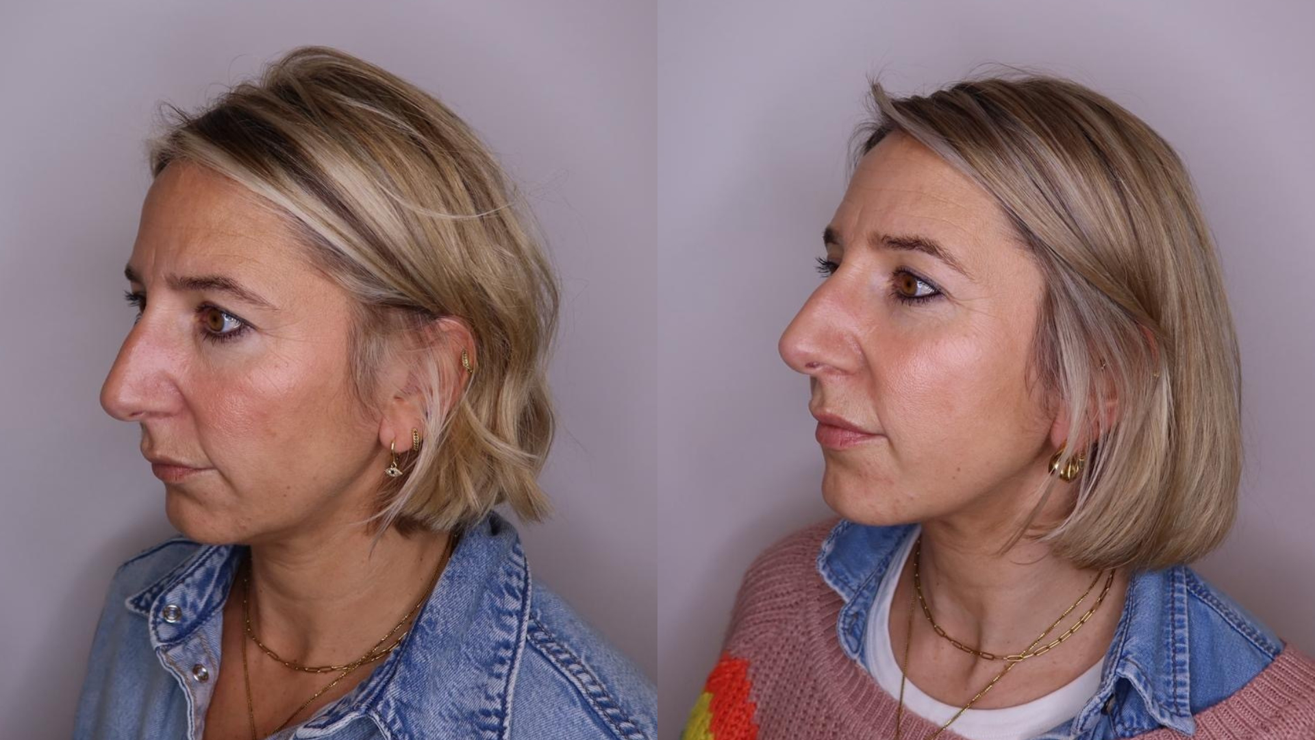 Editor in chief Hannah before (left) and after (right) Sculptra