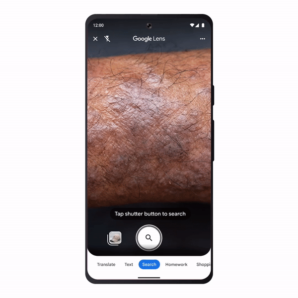 Google Lens' new skin condition feature for discovering possible ailments.