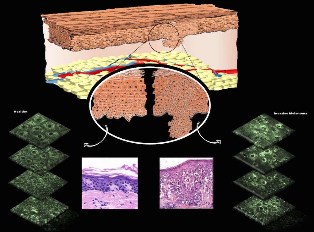 Skin Cancer Diagram